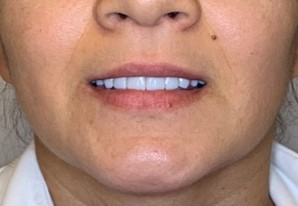 All-in-4 method case after the procedure