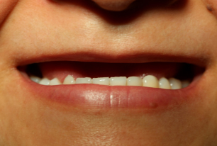 All-in-4 method case before the procedure