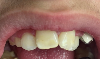 Brown spot removal case after procedure