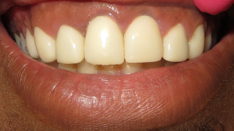 Case of crown implantation after procedure